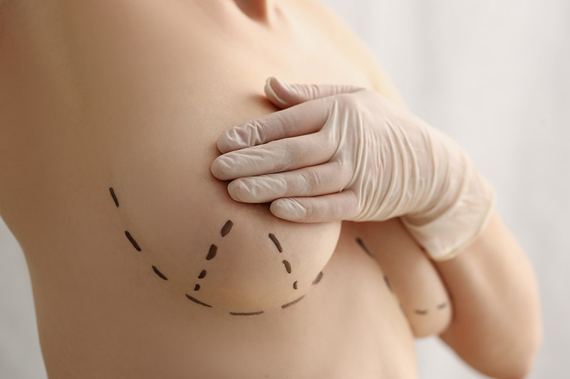 Side Manavgat Antalya Breast Reduction Operation