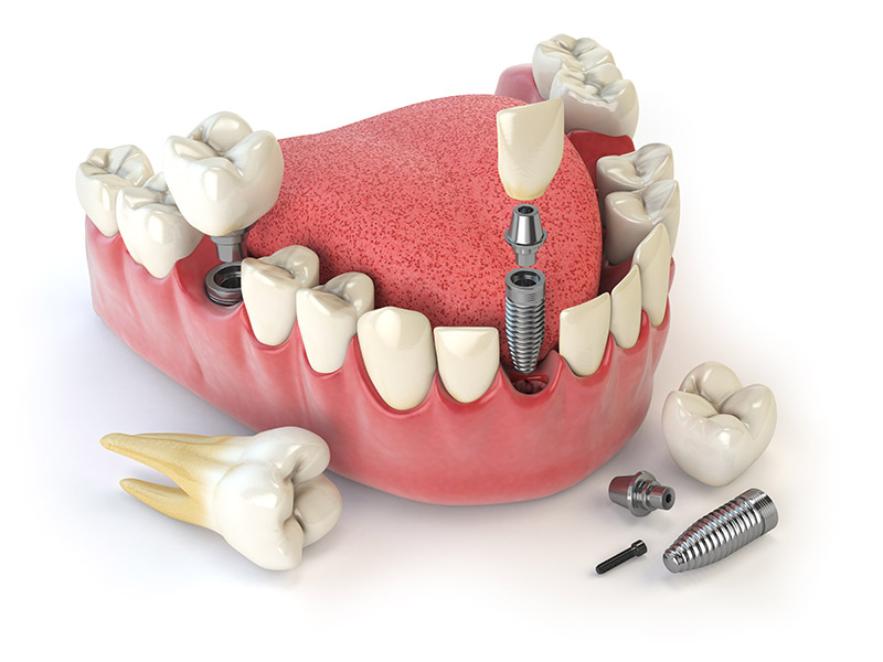 Dental implant treatment process