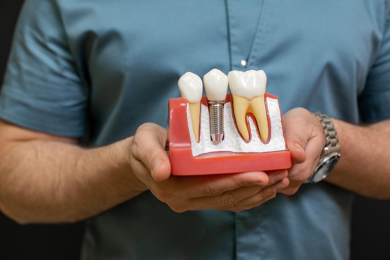 What is a dental implant Best solutions in Side Manavgat
