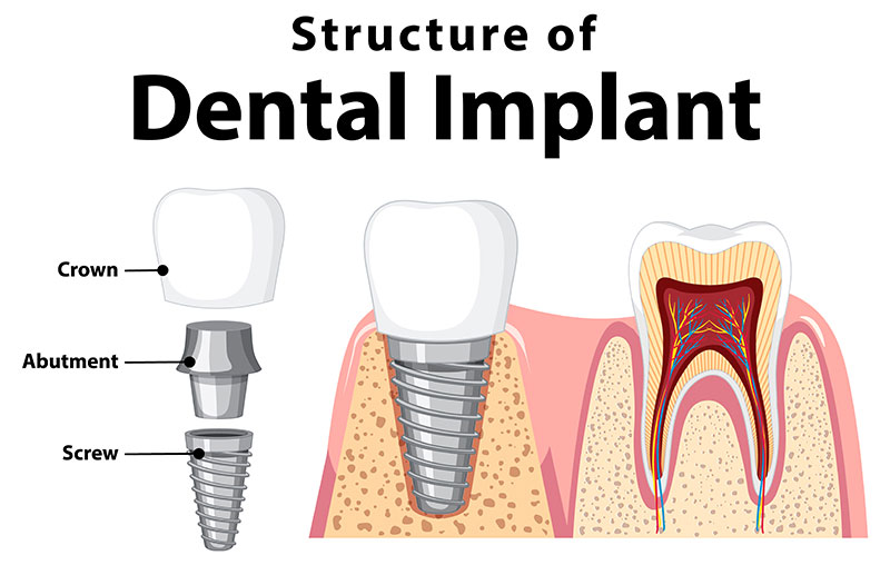 dental implant solutions side