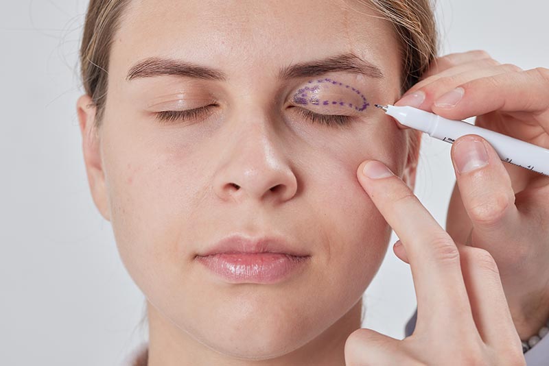 Eyelid lift in Side Manavgat