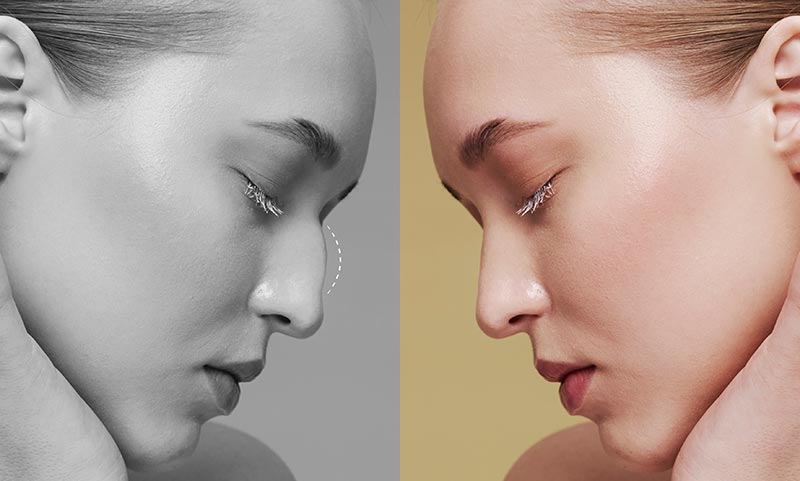 Latest technologies and trends in rhinoplasty