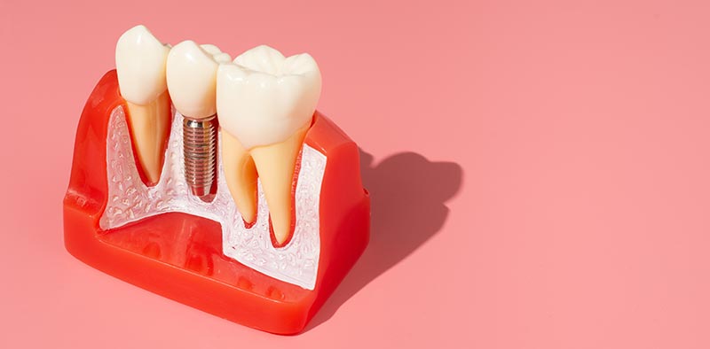 Side-Manavgat-Dental-Implant-Treatment-duration,-prices-and-modern-technologies-2025