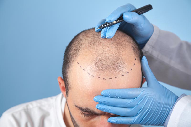 Haartransplantation in Side