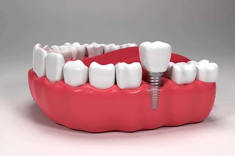 Dental implants in Antalya