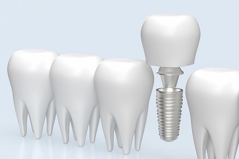 Advantages of dental implant treatment