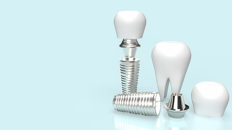 What is a dental implant