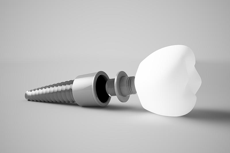 Side dental implant guide