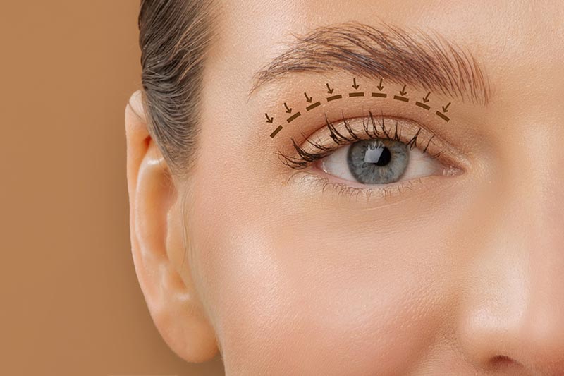 Lateral eyelid lift in Side