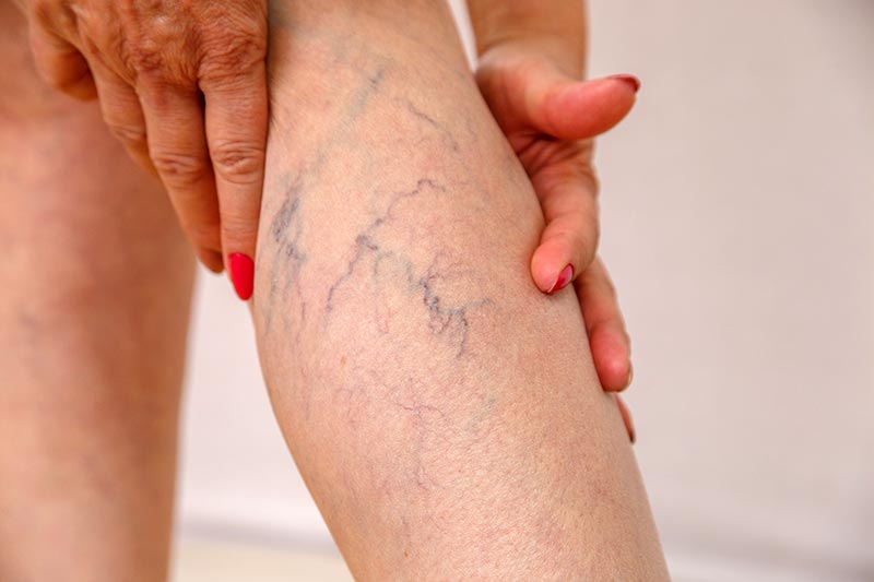 Varicose veins treatment in Side