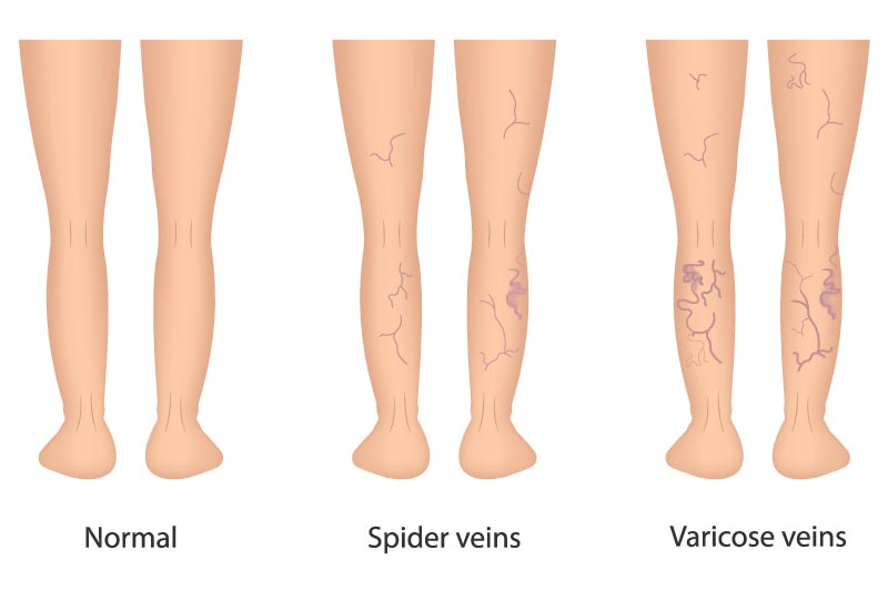 What is varicose vein