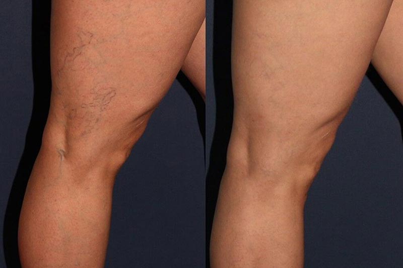 What are varicose veins? Basic definition and physiological role