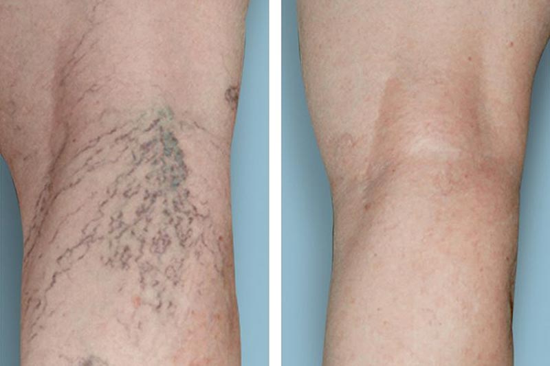 Varicose vein symptoms