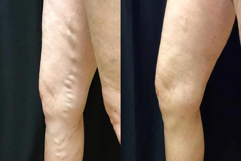 What you should consider when choosing a varicose vein treatment