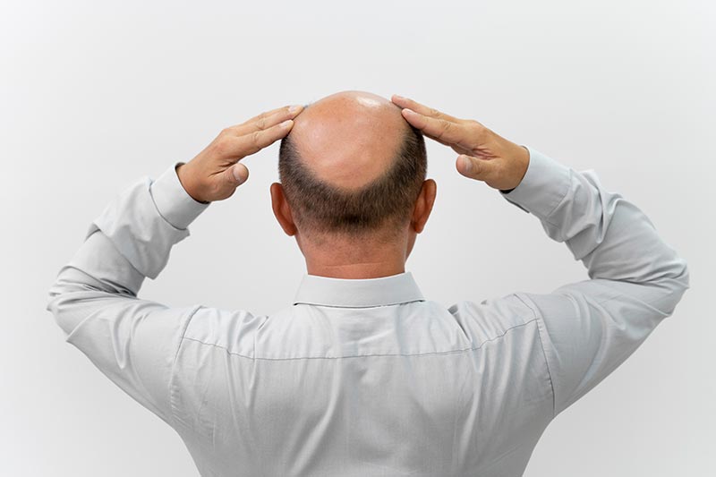 hair transplant