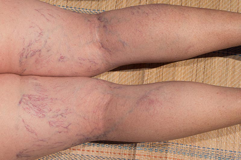 what are varicose veins