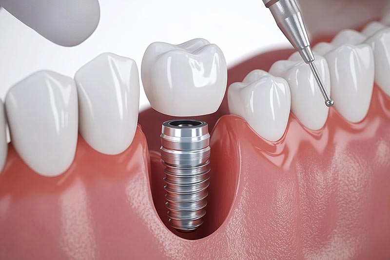 Diş implantı